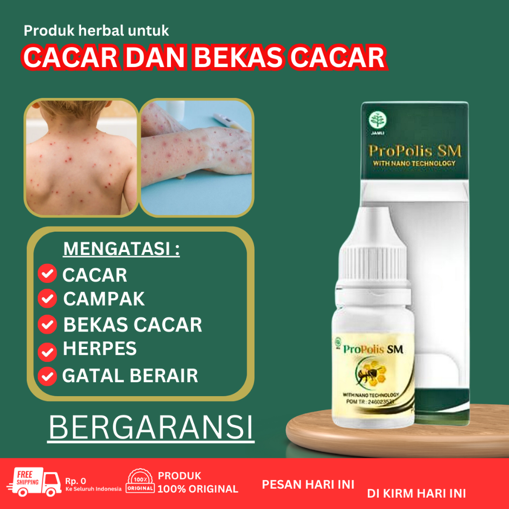 Salep Cacar , Obat Campak Anak / Dewasa, Obat Cacar Air, Cacar Api, Cacar Ular, Cacar Monyet, Cacar 
