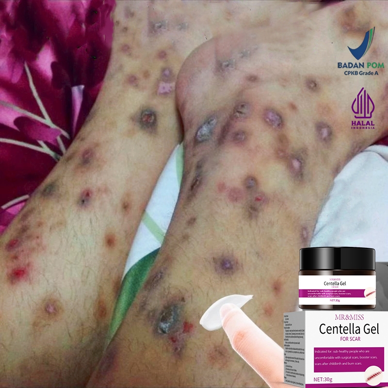 Penghilang bekas luka hitam koreng menghilangkan bekas luka di kaki 30g cream penghilang bekas luka 