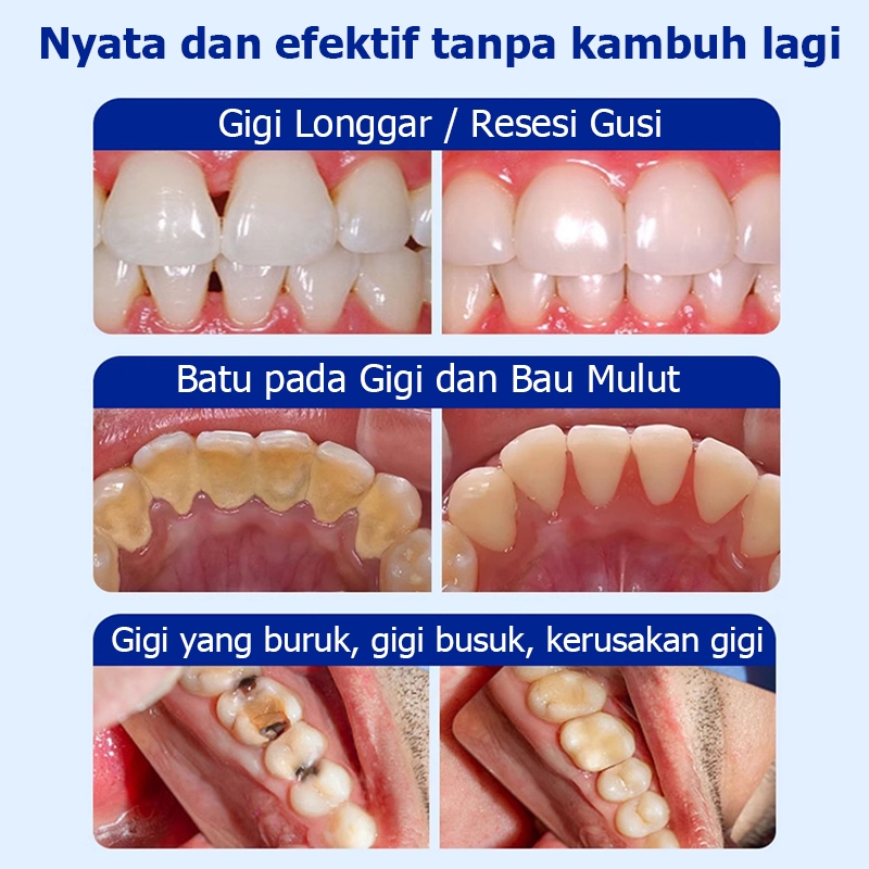 RB22 Odol pemutih gigi dan karang gigi perontok karang gigi paling ampuh penghilang karang gigi