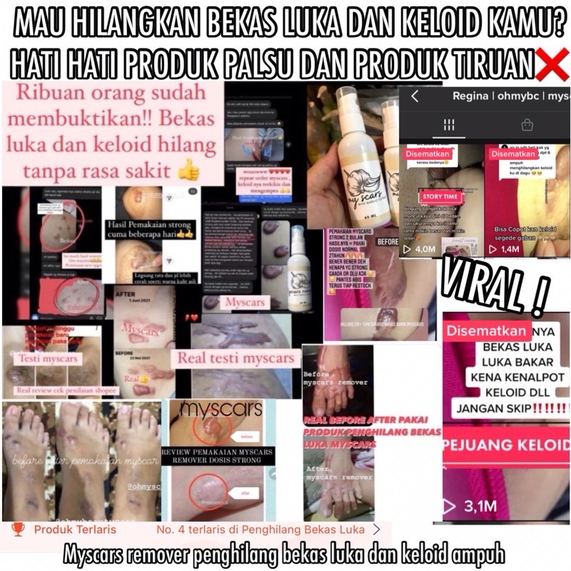 READY STOCK MYSCARS [size mini/trial] | EXFOLIATING SCAR | PENGHILANG KELOID | PENGILANG BEKAS LUKA 