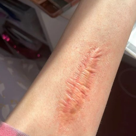 REALISTIC KELOID SCAR | BEKAS LUKA PALSU | SFX PROSTHETIC SILICONE | SFX PROSTETIK | SFX MAKEUP | SF