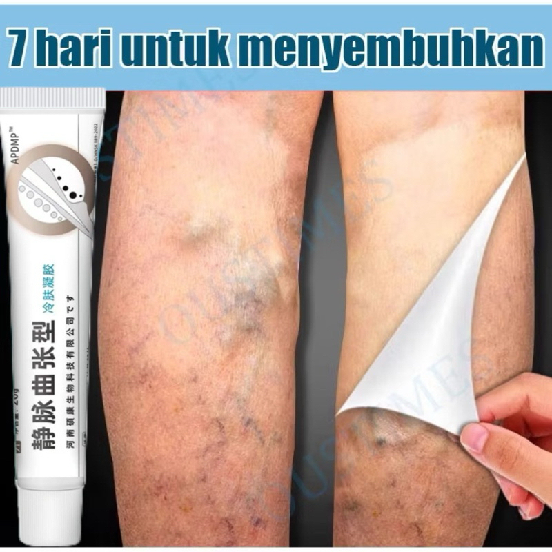 Varicose Veins Cream Obat Varises Salep Penghilang Varises Vaskulitis Varicose Veins Obat Varises Sa
