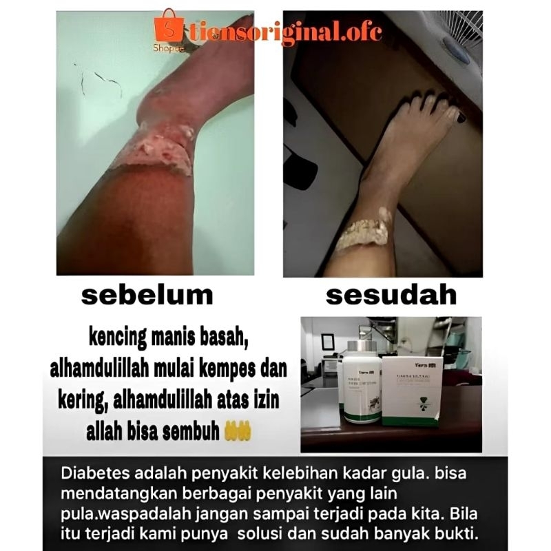 

GFD Tiens Shutang Kalsium Powder - Susu Labu Cina untuk Penderita Diabetes & Gula Darah