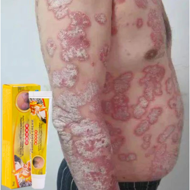 Salep Gatal Paling Ampuh salep kadas kurap gatal ampuh Gatel Eksim Kering Menahun Exim Basah Kulit S