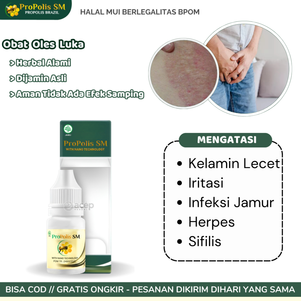 Obat Lecet Kelamin Iritasi Infeksi Jamur Herpes Sifilis Alergi Kulit Kutil Kelamin Propolis SM