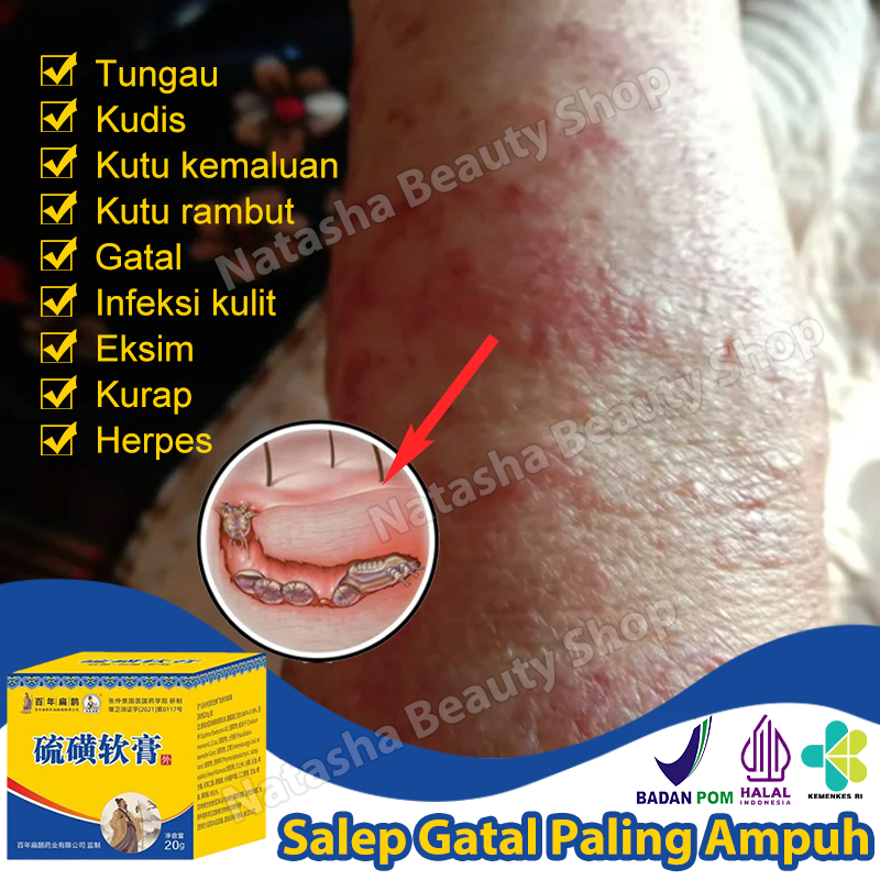 100% ORI Salep gatal paling ampuh salep gatal selangkangan Salep Tungau Kudis Kutu kemaluan 20g Anak
