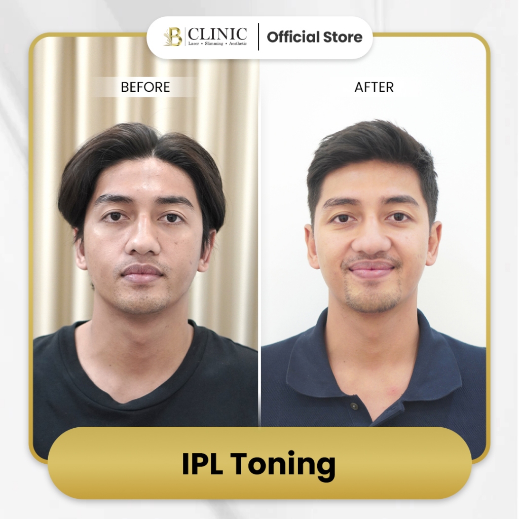 B CLINIC IPL TONING