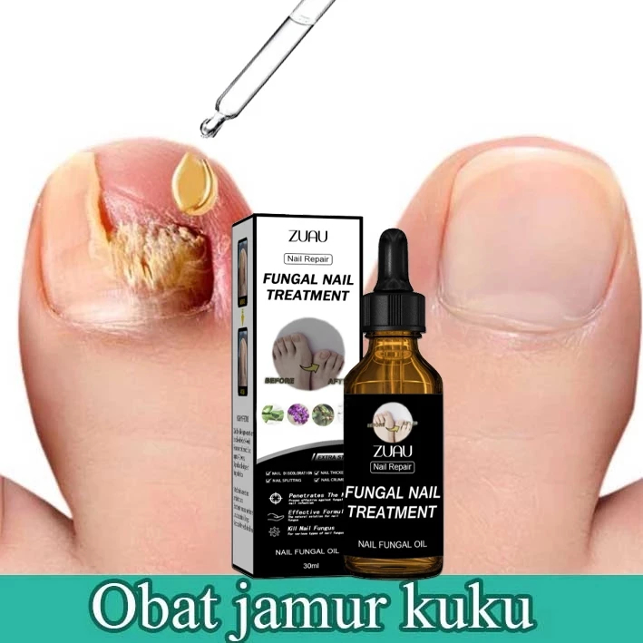 30ml Obat Jamur Kuku Obat kuku jamur dan rusak Perawatan Kuku Berjamur Antibakteri Perawatan Kuku On