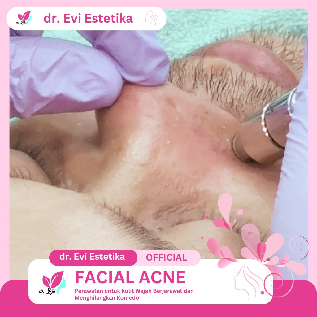 dr. Evi Estetika Facial Acne dan Komedo