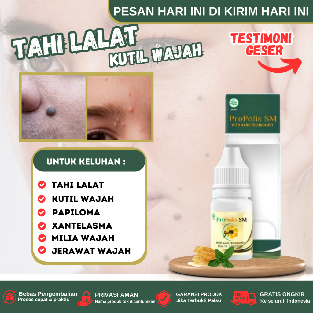 Propolis SM - Penghilang tahi lalat, Obat penghilang tahi lalat di wajah, Obat tahi lalat di wajah, 