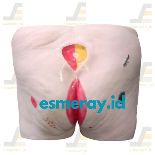 Dekubitus/Ulkus/Bedsores/Manikin/Manekin Simulator Bokong Decubitus/Luka Baring Praktek Edukasi