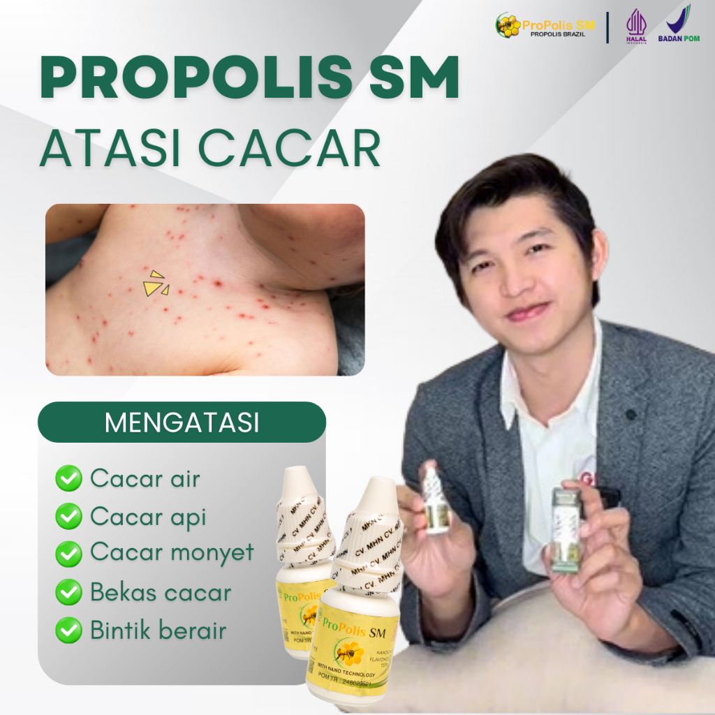 Obat Cacar , Obat Cacar Air, Obat Cacar Api, Obat Cacar Air Anak, Obat Cacar Air Dewasa, Obat Penghi