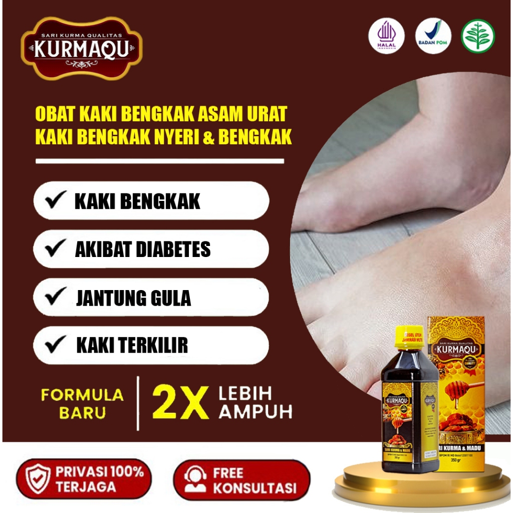 Obat Kaki Bengkak, mengobati kaki bengkak akibat asam urat, Kaki Bengkak dan Nyeri, Kaki Bengkak dan
