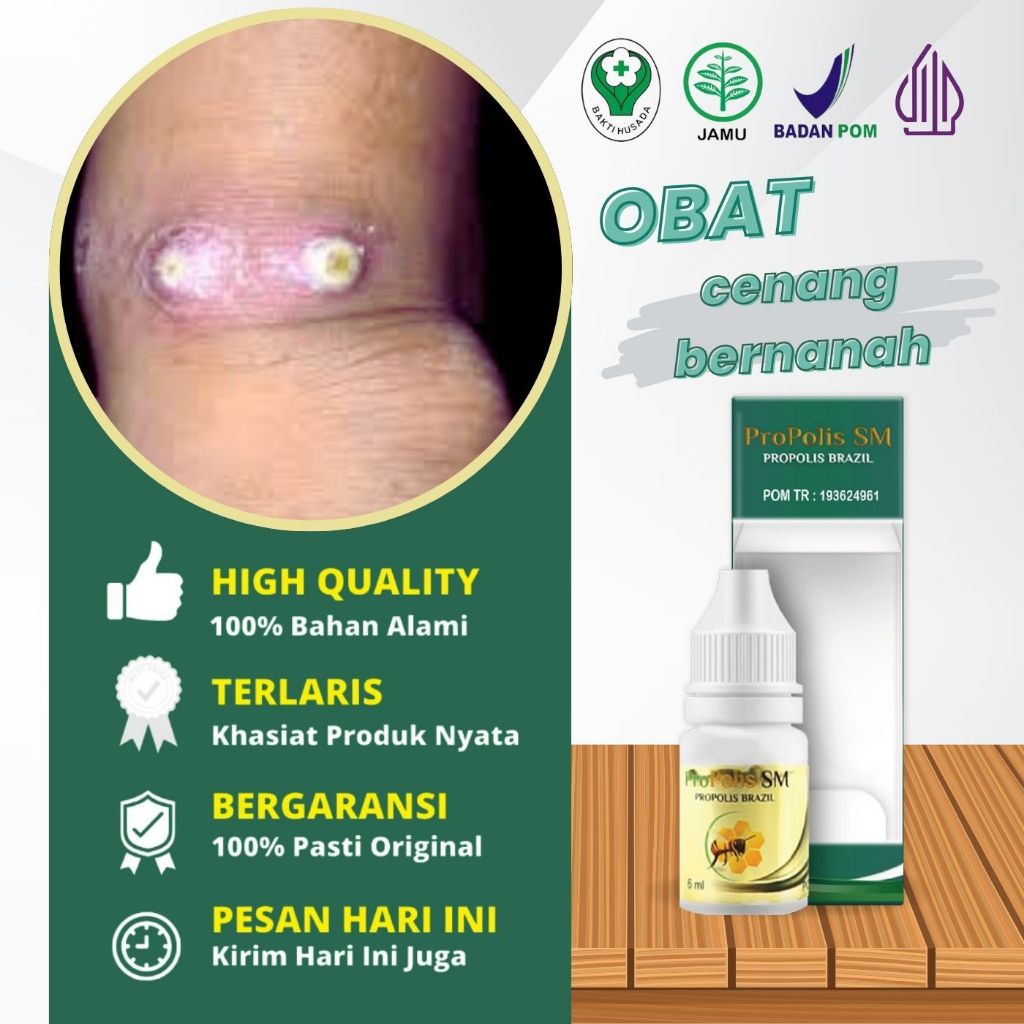 Obat Cenang Bernanah, Cenang Di Tangan, Cenang Di Kaki, Obat Gatal Bernanah, Kulit Nanahan, Luka Bor