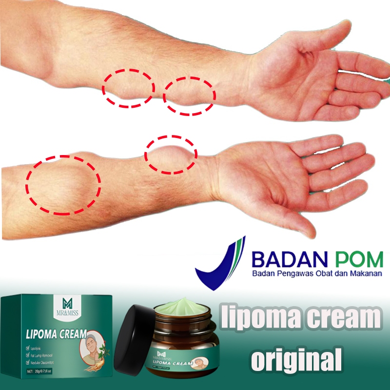 Lipoma cream original Obat benjolan Lipoma removal cream original Obat lipoma Salep lipoma salep ben