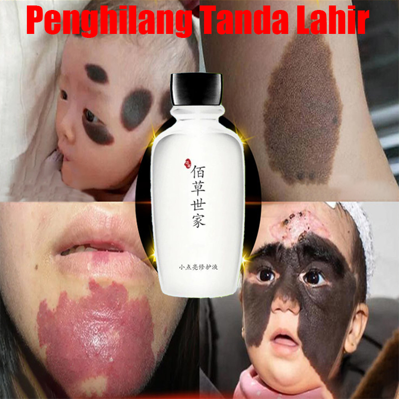 Penghilang Tanda Lahir Obat Penghilang Tanda Lahir Coklat, Merah, Hitam Penghilang Tanda Lahir Di Wa