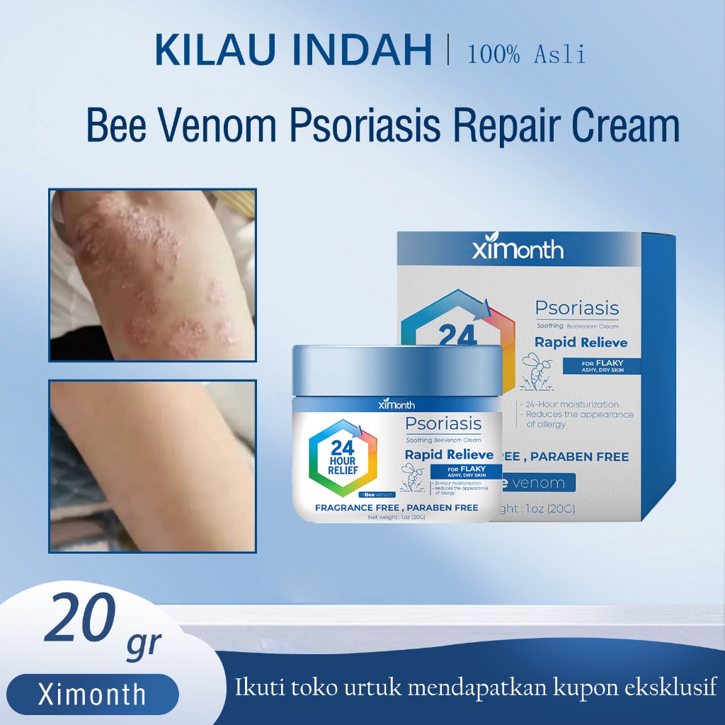 ORI obat gatel Krim Antibakteri Psoriasis 20g Pruritus Salep Gatal Psoriasis Cream For Dermatitis, J