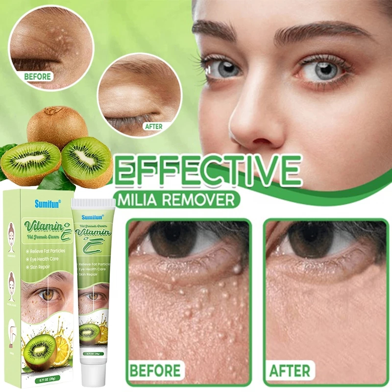 SHVA. penghilang milia paling ampuh krim 20g penghilang milia syringoma xanthelasma butiran lemak