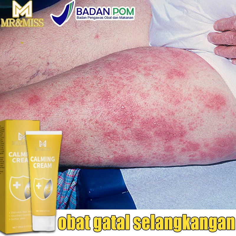 Obat gatal selangkangan Salep gatal selangkangan Obat gatal gatal Salep gatal jamur selangkangan 20m