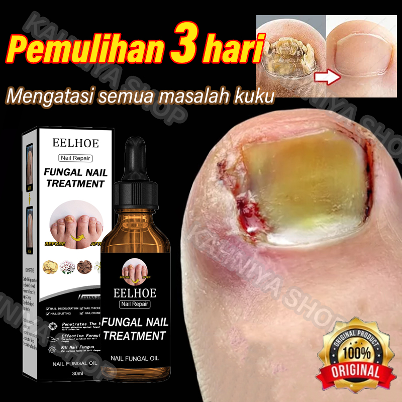 serum kuku obat kuku jamur dan rusak obat kuku jamur dan rusak obat jamur kuku vitamin kuku dan kuti