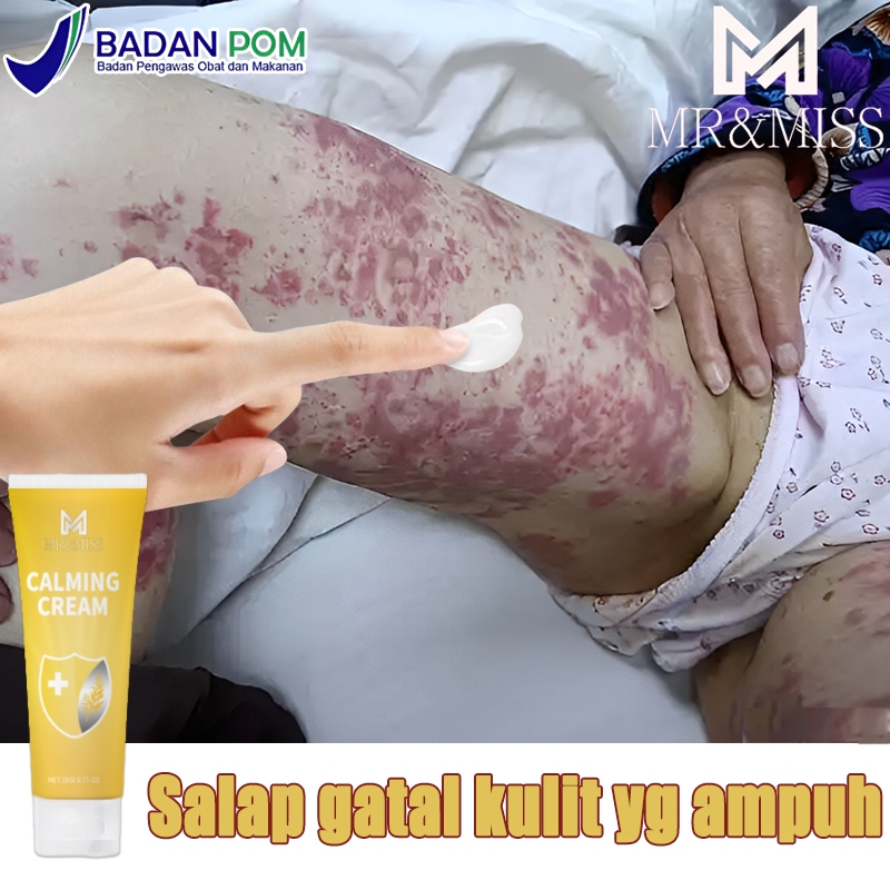 Salep gatal kulit yang ampuh Obat gatal selangkangan Salep gatal china paling ampuh 20ml salep china