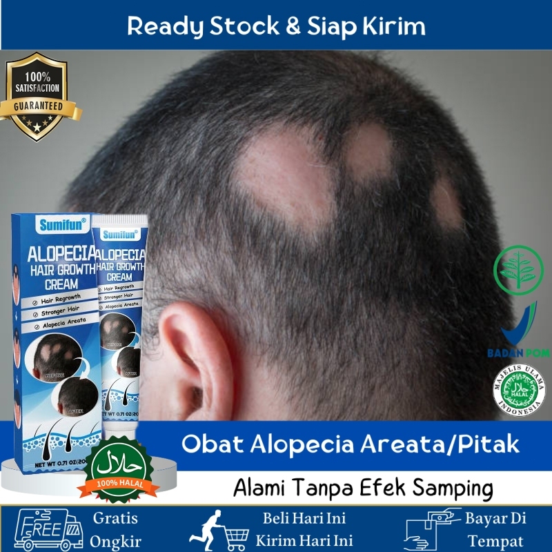 Sumifun Obat Pitak, Obat Botak Koin, Obat Oles Alopecia Areata, Penumbuh Rambut Rontok Di Kepala, Ob