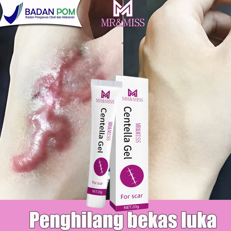 Salep penghilang bekas luka Penghilang bekas luka hitam koreng Obat penghilang bekas luka Menghilang