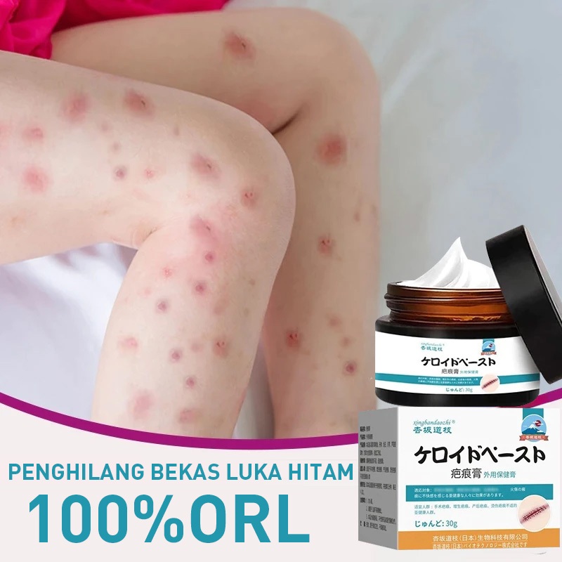 Penghilang bekas luka hitam koreng Penghilang bekas luka di kaki Penghilang Bekas cacar Bekas gigita