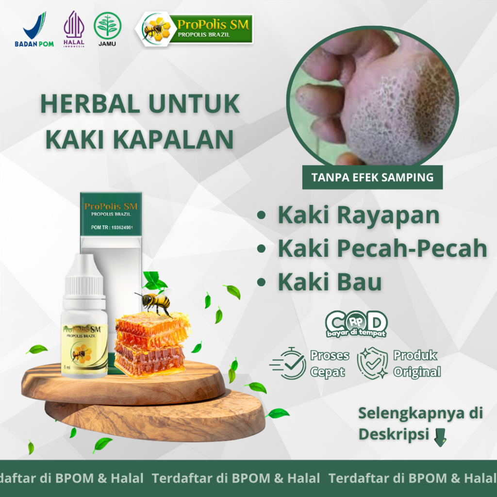 Obat Kaki Rayapan, Obat Kaki Berlubang, Obat Kaki Pecah-Pecah Dengan Propolis SM
