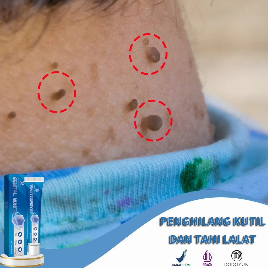 Obat penghilang kutil Obat kutil kelamin Penghilang kutil dan tahi lalat 1botol Obat tahi lalat Peng