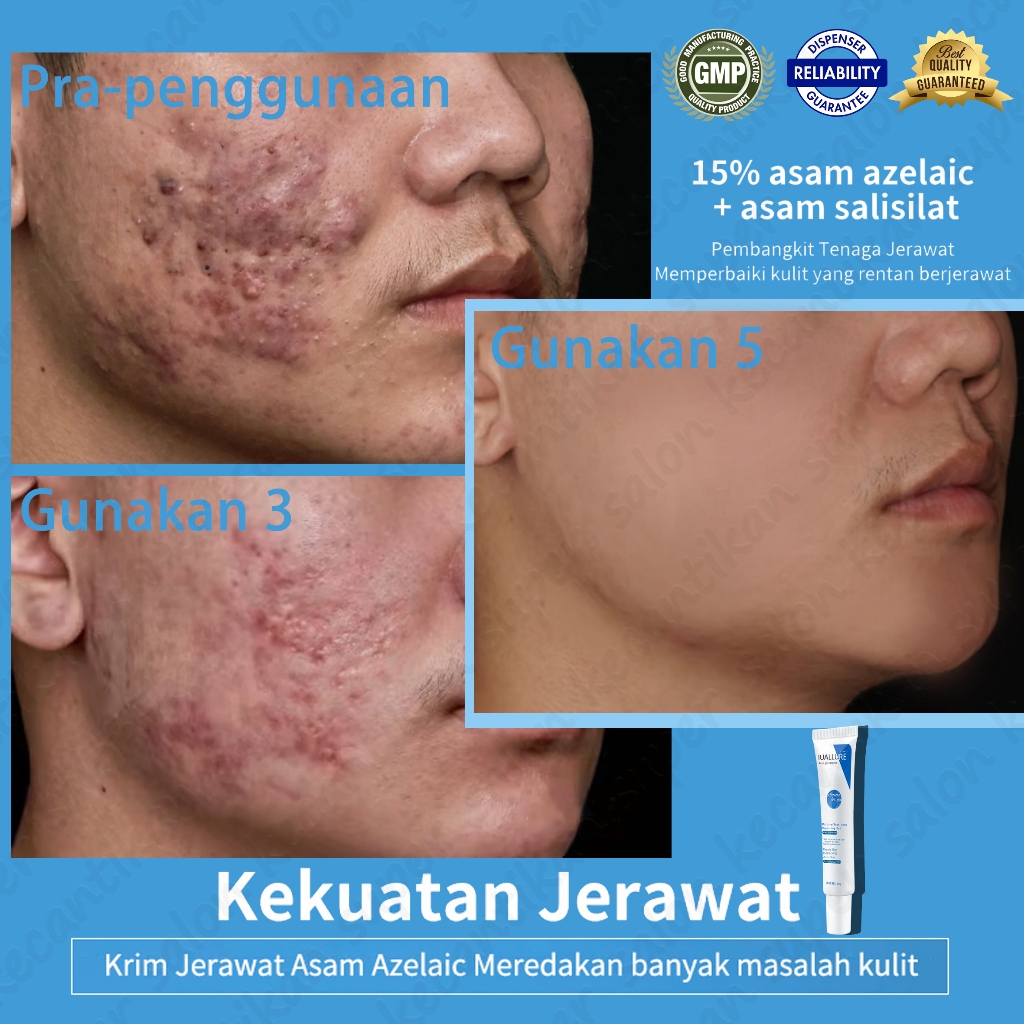 Krim Jerawat Acne spot gel Acnes sealing gel 20G IUALLURE PENGHILANG JERAWAT acne cream jerawat para