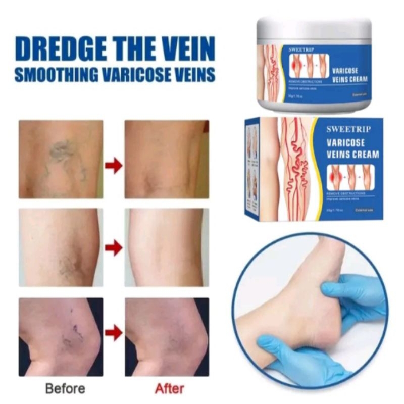 SALEP VARISES VARIKOSE Salep varises 50gr
