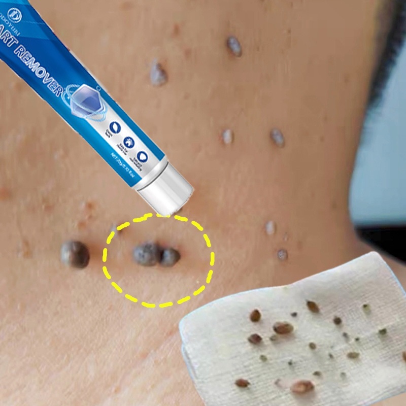 Obat penghilang tahi lalat obat penghilang kutil obat kutil paling ampuh 100%Original obat kutil kel