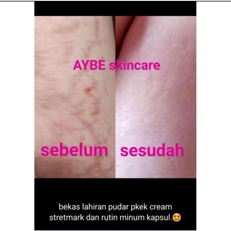 Cream stretchmark aybe skincare