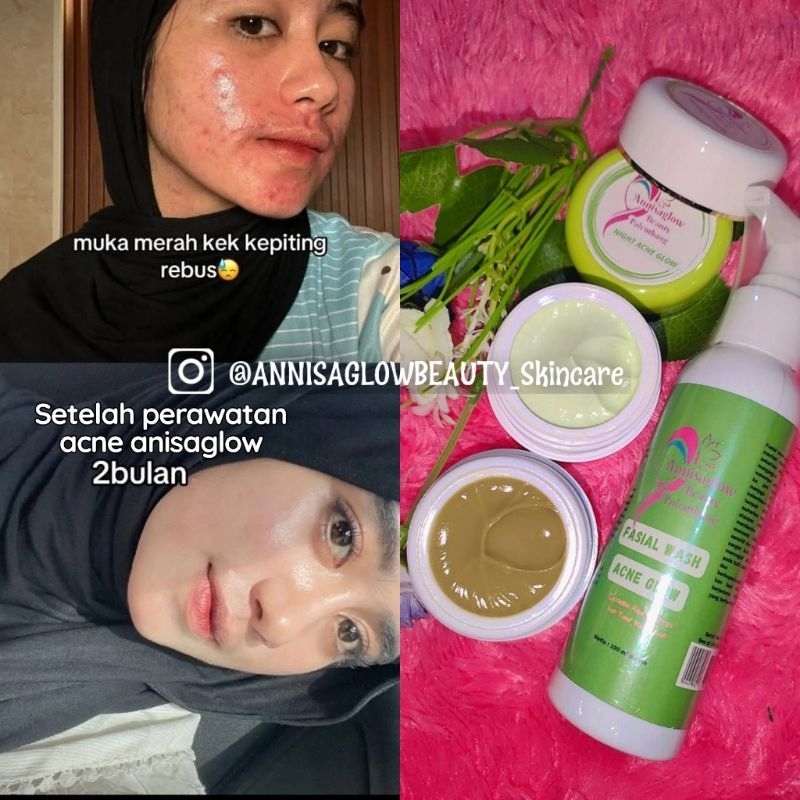 CREAM ACNE GLOW AMPUH HILANGKAN JERAWAT SAMPAI KE AKARNYA