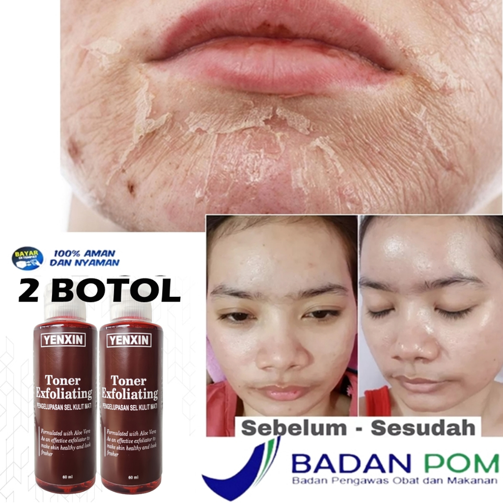 2 BOTOL TONER KELUPAS MUKA YENXIN TONER TONER STRONG TONER KELUPAS WAJAH /TONER PENGELUPASAN WAJAH D