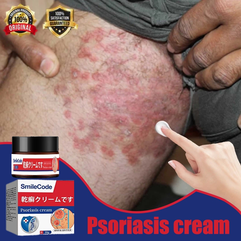 Obat gatal selangkangan salep gatal jamur selangkangan salep gatal china paling ampuh obat gatel 30g