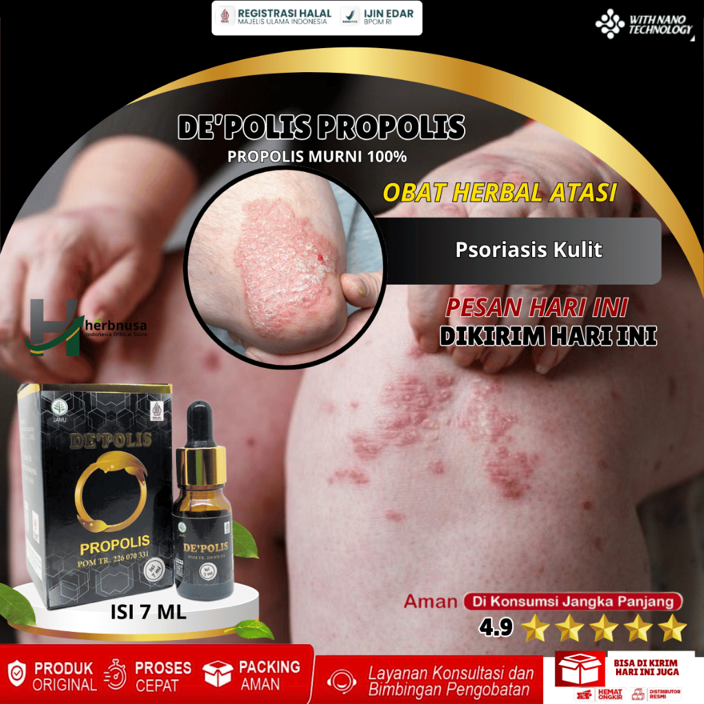 Obat Psoriasis Gatal Kulit Psoriasis Obat Kulit Bersisik Di Siku Tangan Lutut Kulit Bersisik Dan Teb
