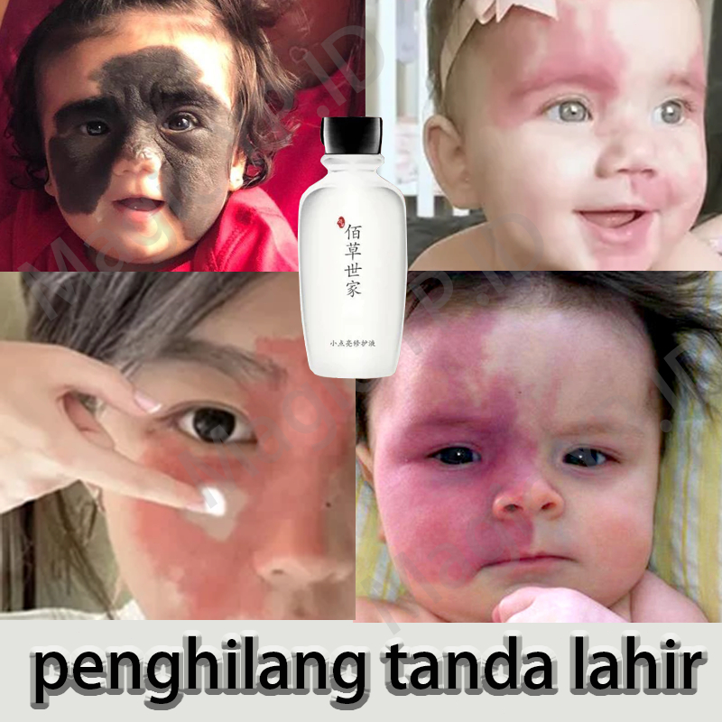 Memudarkan Tanda Lahir Penghilang Tanda Lahir