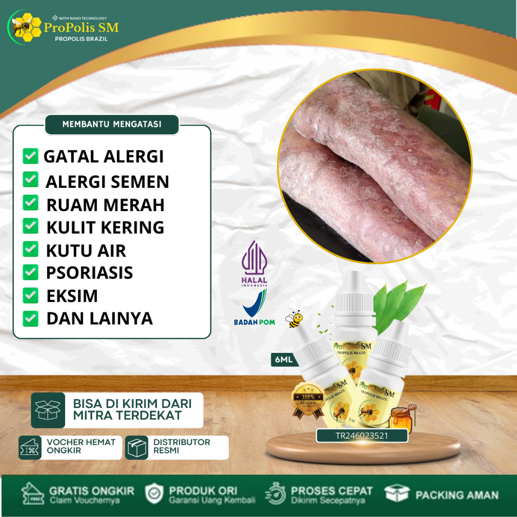 Propolis SM - Obat Alergi Semen Gatal Dermatitis Kontak Atopik Seboroik Kulit Kering Bersisik Kulit 