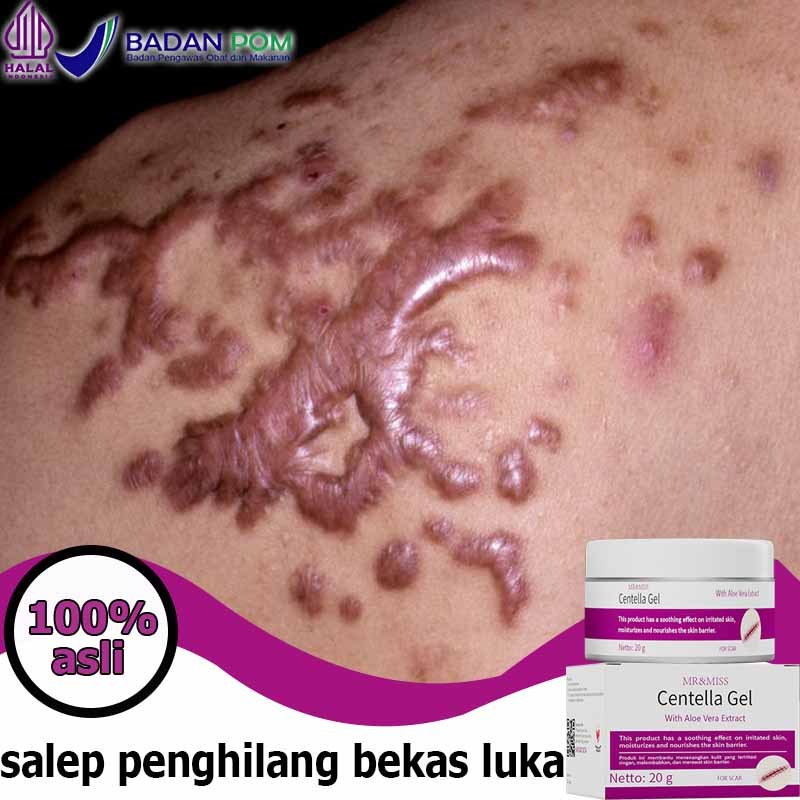 Salep penghilang bekas luka Penghilang bekas luka hitam koreng Obat penghilang bekas luka Bio herbal
