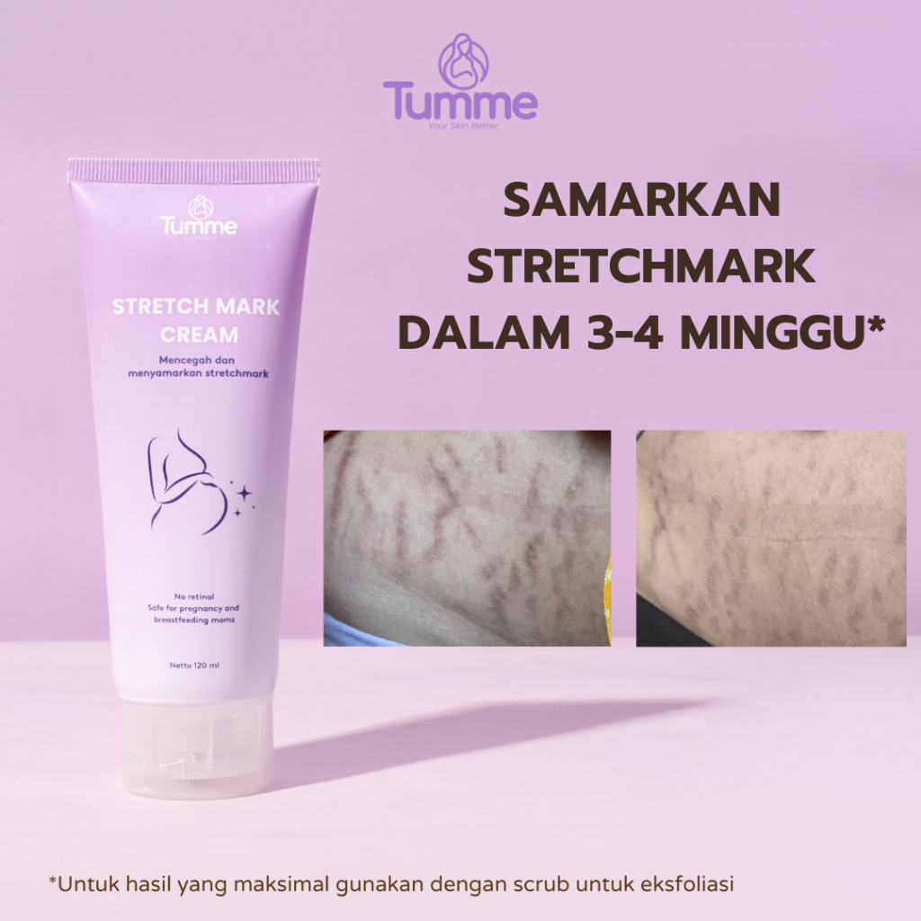 Stretchmark Cream Penghilang Stretch Mark Ibu Hamil & Pasca Melahirkan – Ampuh Samarkan Garis Putih 
