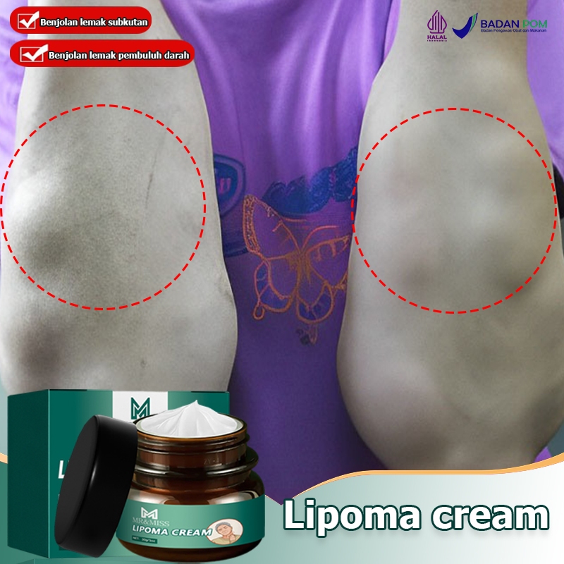 Lipoma cream original Obat benjolan Lipoma removal cream original Obat lipoma Salep lipoma salep ben