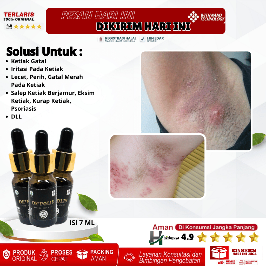 Obat Ketiak Gatal, Iritasi Pada Ketiak, Lecet, Perih, Gatal Merah Pada Ketiak, Salep Ketiak Berjamur