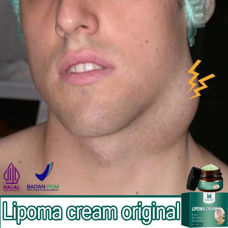 Lipoma cream original obat benjolan obat lipoma lipoma removal cream original 30g obat kista salep b