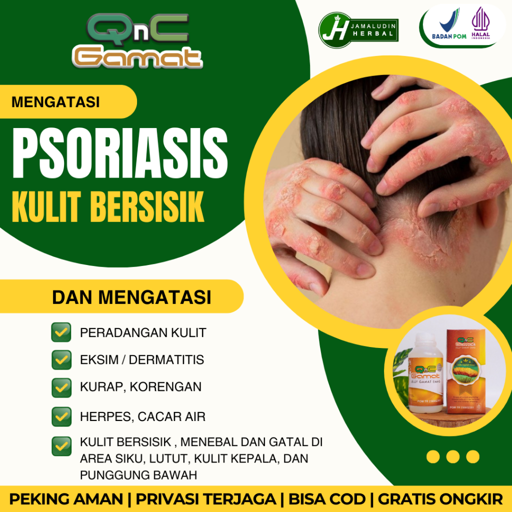Obat Psoriasis Di Kepala, Psoriasis Di Siku Tangan, Obat Gatal Psoriasis, Obat Kulit Bersisik