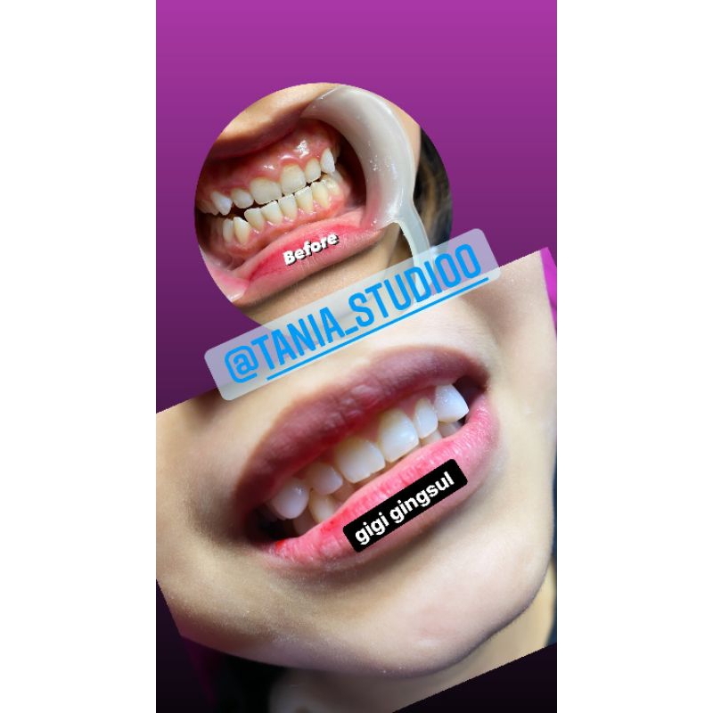 Veneer Gigi Gingsul Germany