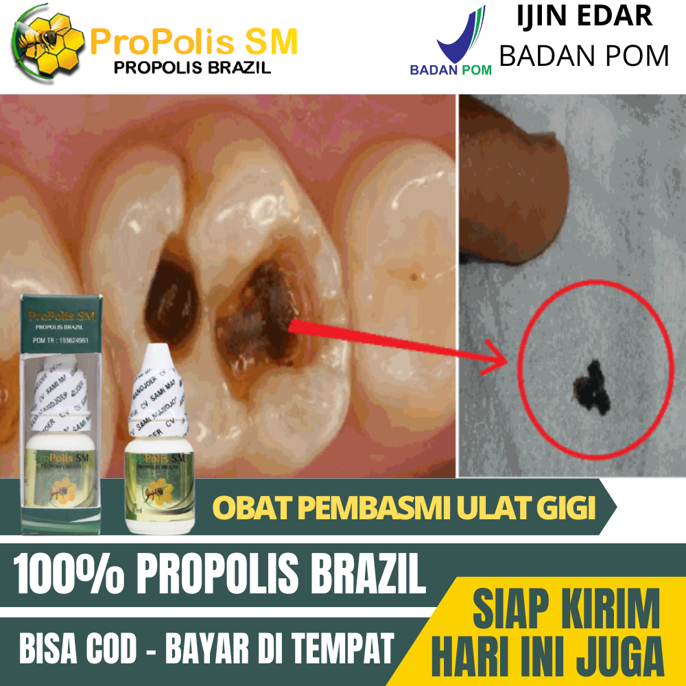 OBAT KUMUR ULAT GIGI - PENGHILANG ULAT GIGI - GIGI BERLUBANG DAN KEROPOS | PROPOLIS SM Perontok ulat