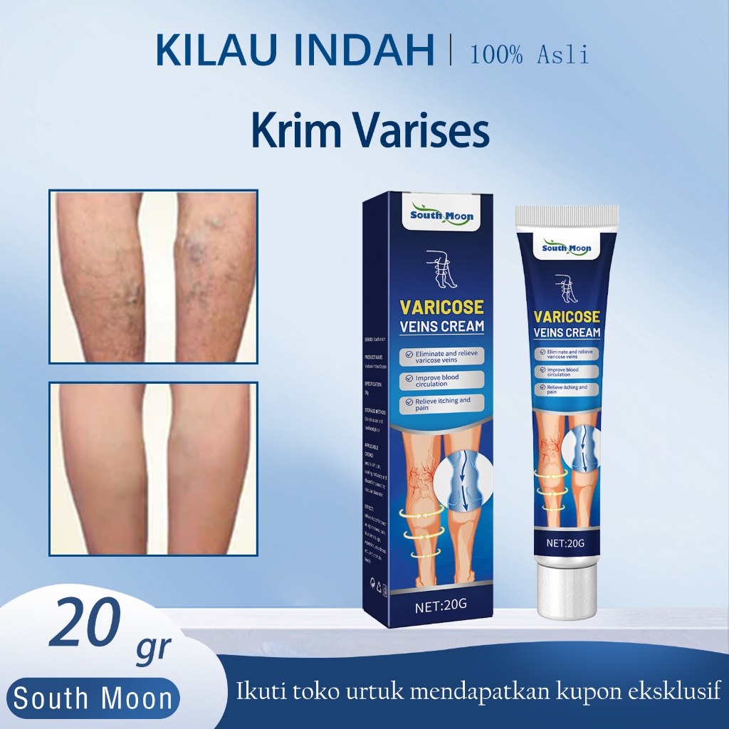 【Ori】South Moon Salep Varises 20g - Krim Varises Krim Varises Untuk Kaki Bagian Bawah Dan Telapak Ka