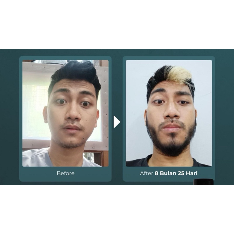 BEST SELLER TERMURAH TERLARIS KEMASAN BARU NEW PACK MINOXIDIL MADE IN ISRAEL COTSCO USA CANADA NORVI